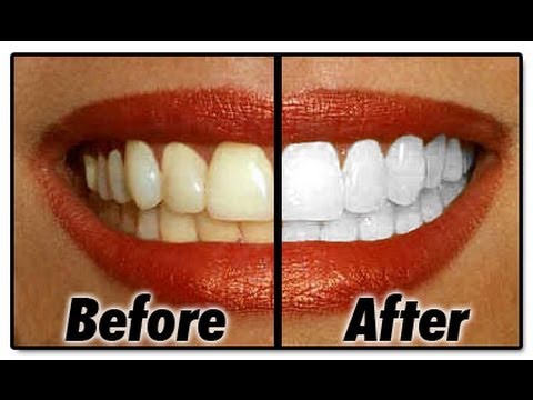 VIDEO: Kako izbijeliti zube za 2 minute?