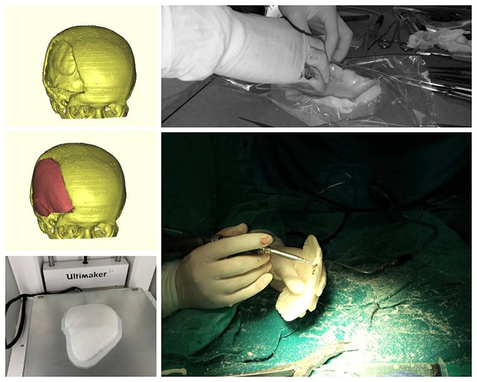 U KBZ urađena prva 3D rekonstrukcija koštanog defekta glave (FOTO)