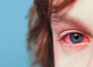 Pet načina kućnog liječenja konjuktivitisa