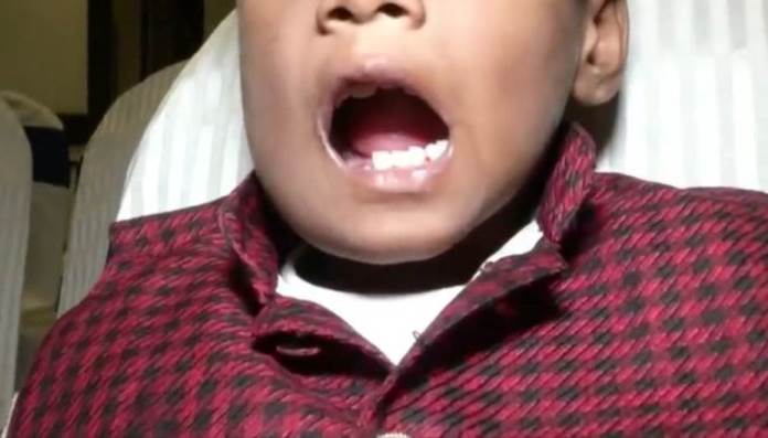 Iz usta sedmogodišnjeg dječaka izvađeno 526 zuba