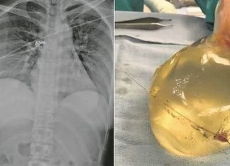 Implantati koje je imala u grudima zaustavili metak na putu do srca