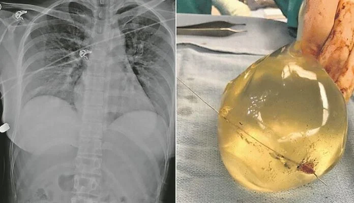 Implantati koje je imala u grudima zaustavili metak na putu do srca