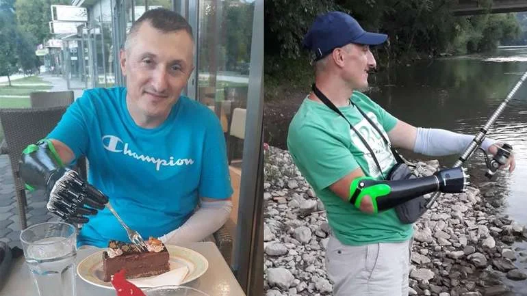 Zeničanin sa robotskom rukom: Motiv za život Raim Redžić