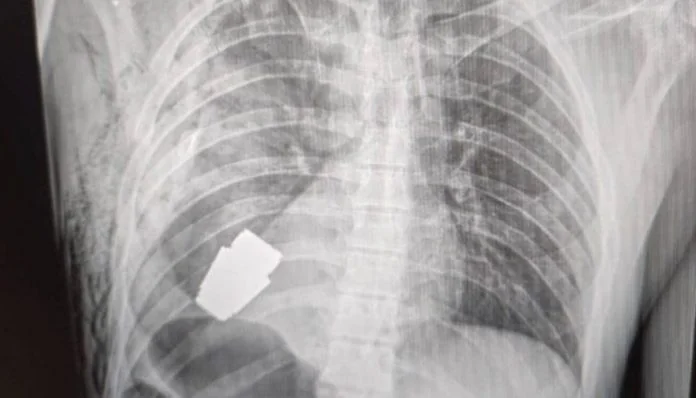 Ukrajinski Vojnik Rengen Granata U Tijelu