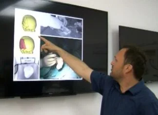 Pionirski poduhvat zeničkih ljekara postao standardna operacija 3D Modeliranje Kosti Glave