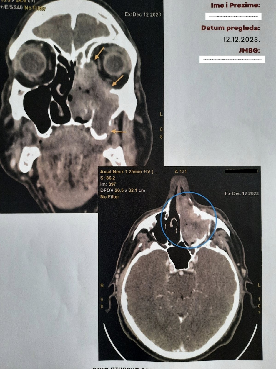CT Glave S Karcinom Koji Je Zahvatio Lijevu Polovinu Lica Uz Destrukciju Kostanih Struktura