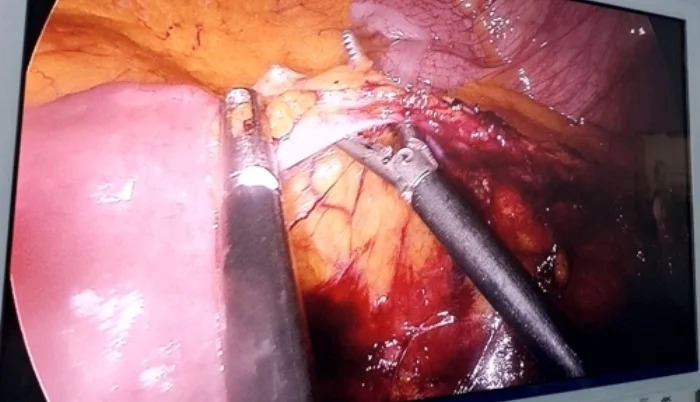 U Kantonalnoj bolnici Zenica izvedena savremena laparoskopska operacija karcinoma rektuma