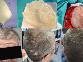 KBZE 3D Kranioplastika