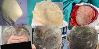 KBZE 3D Kranioplastika