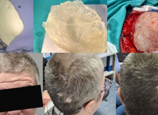 Na Odjelu neurohirurgije KBZ urađena nova 3D kranioplastika (FOTO) KBZE 3D Kranioplastika