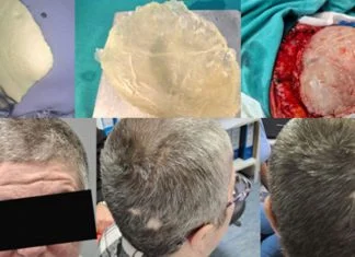 Na Odjelu neurohirurgije KBZ urađena nova 3D kranioplastika (FOTO) KBZE 3D Kranioplastika