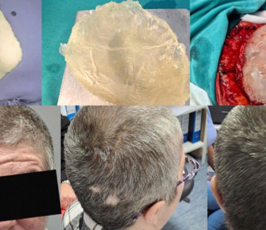 KBZE 3D Kranioplastika