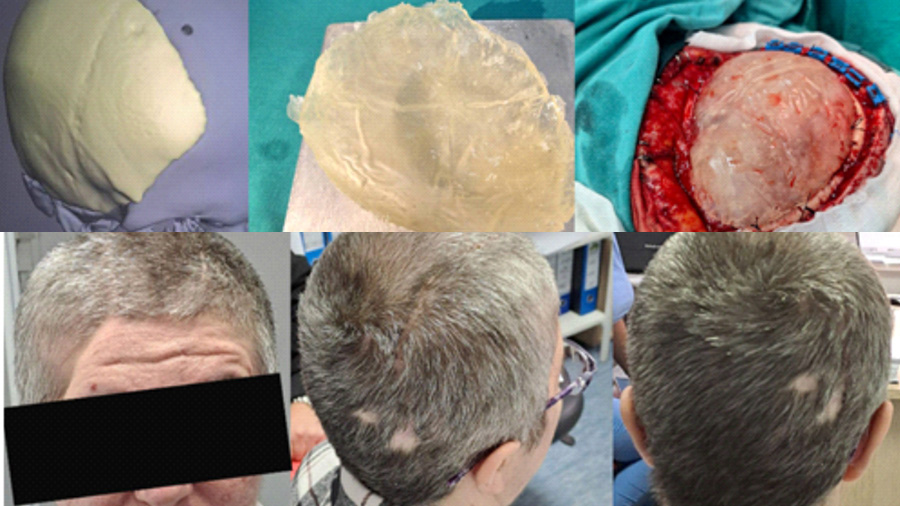 KBZE 3D Kranioplastika