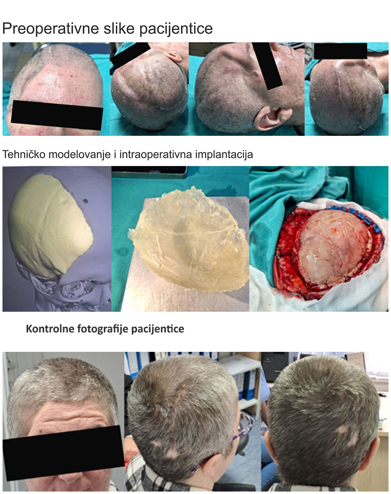 KBZE 3D Kranioplastika